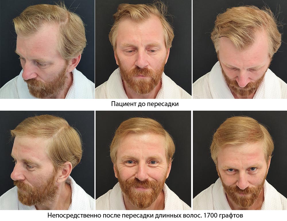 Пересадка длинных волос - до и после. Проф. Акакий Цилосани