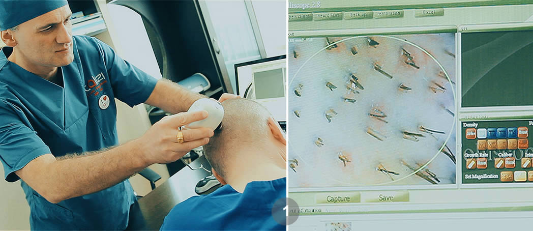 Follicular Unit Excision (FUE). Dr. Tsilosani