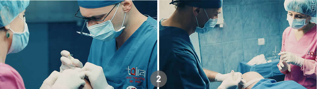 Follicular Unit Excision (FUE). Dr. Tsilosani