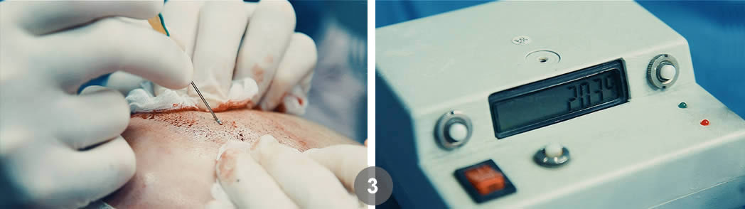 Follicular Unit Excision (FUE). Dr. Tsilosani