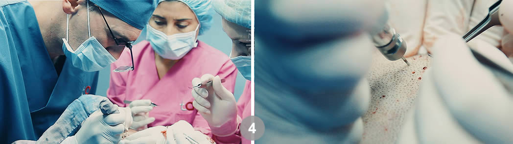 Follicular Unit Excision (FUE). Dr. Tsilosani