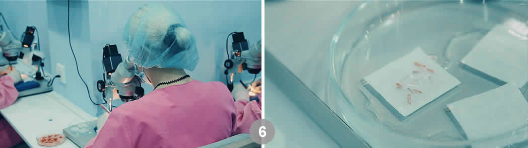 Follicular Unit Excision (FUE). Dr. Tsilosani