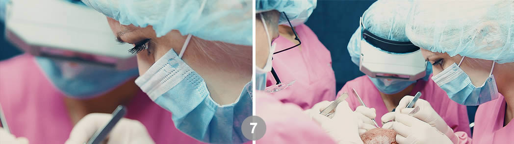 Follicular Unit Excision (FUE). Dr. Tsilosani