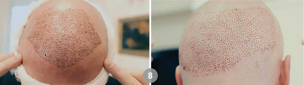 Follicular Unit Excision (FUE). Dr. Tsilosani
