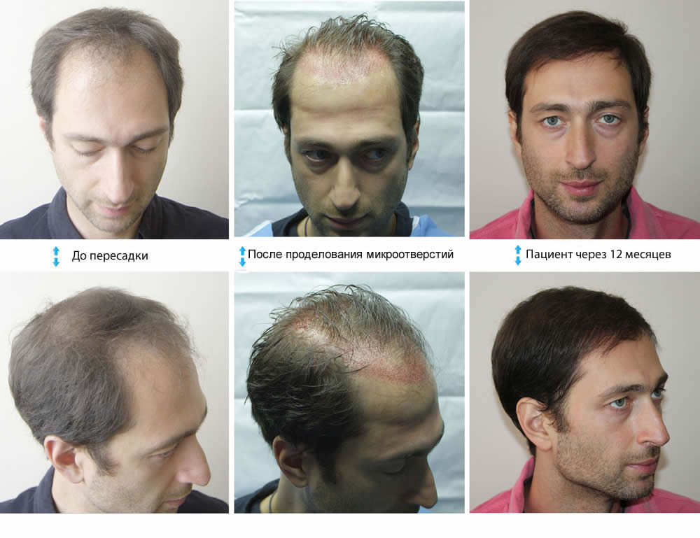 Пересадка длинных волос - до и после. Проф. Акакий Цилосани