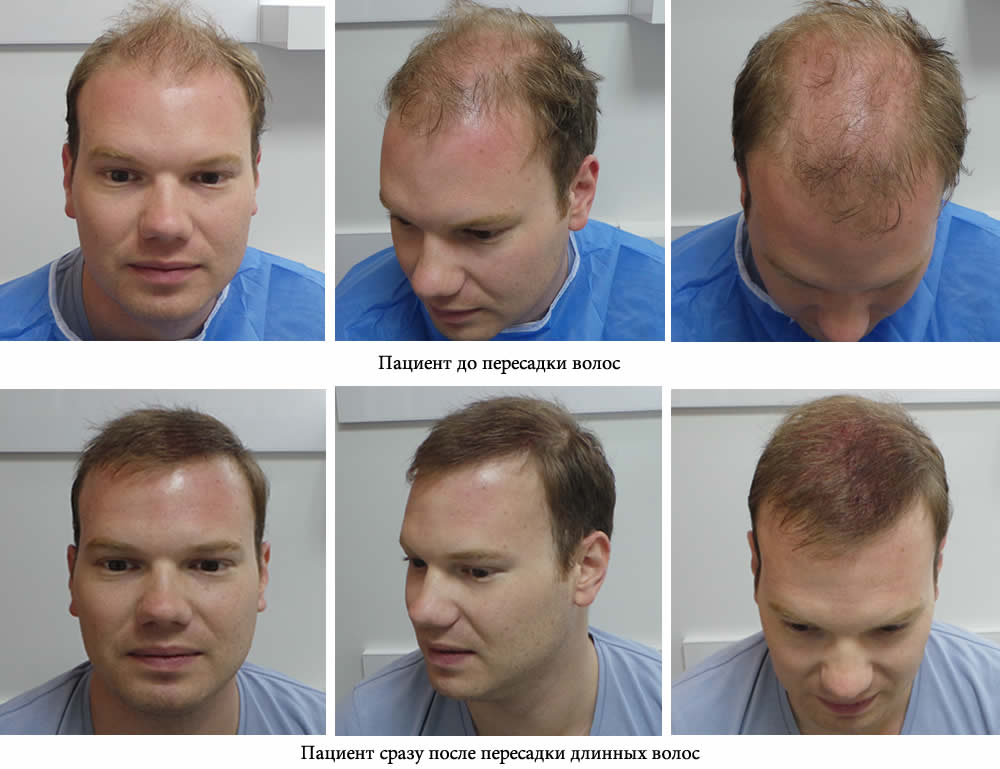 Пересадка длинных волос - до и после. Проф. Акакий Цилосани