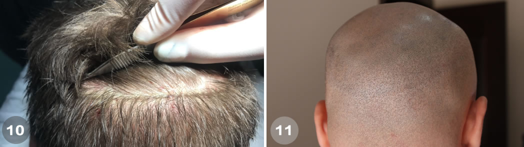 Follicular Unit Excision (FUE)