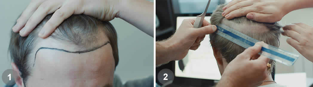 Follicular Unit Excision (FUE)