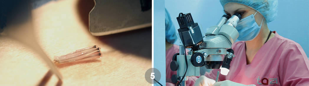 Follicular Unit Excision (FUE)