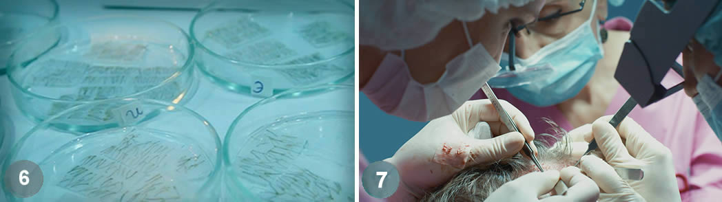 Follicular Unit Excision (FUE)