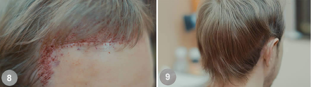 Follicular Unit Excision (FUE)