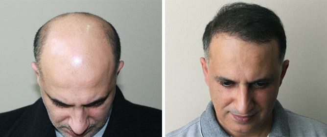 Which Hair Transplant Method is best?