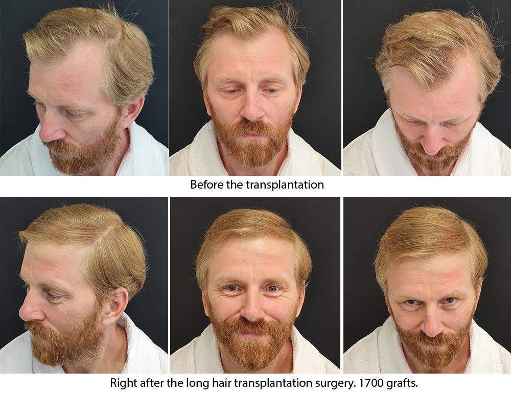 Long Hair Transplant - Before & after. Проф. Акакий Цилосани
