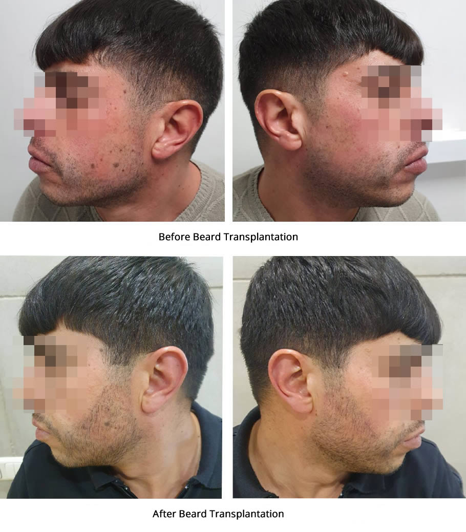 Beard restoration - BHT. Dr. Tsilosani