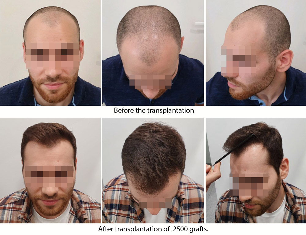 FUE - Dr Akaki Tsilosani, MD, PhD, FISHRS