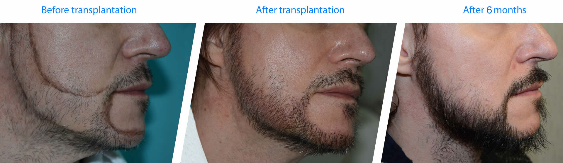 Beard restoration - BHT. Dr. Tsilosani