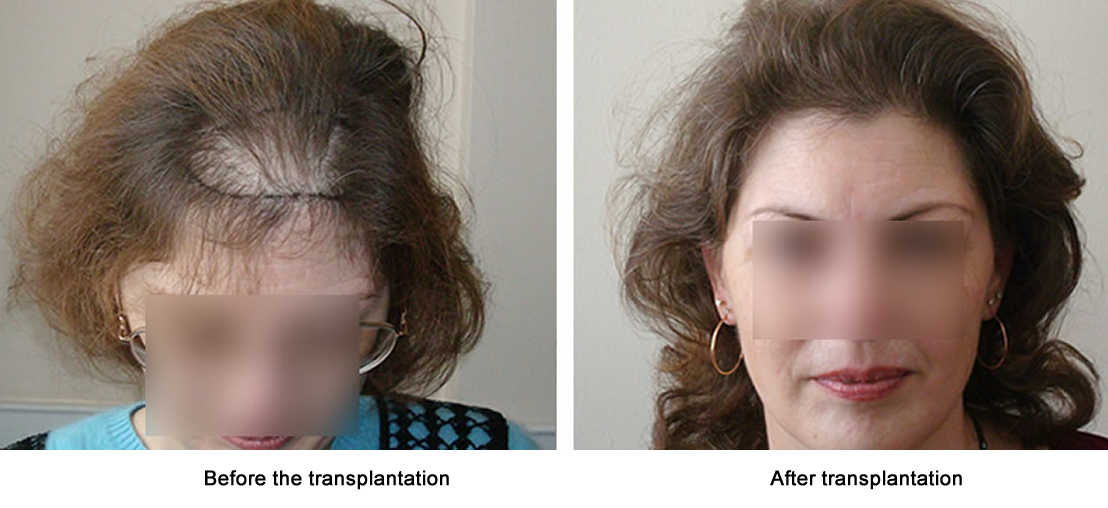 Female hair restoration results -   before and after. Dr Akaki Tsilosani, MD, PhD, FISHRS