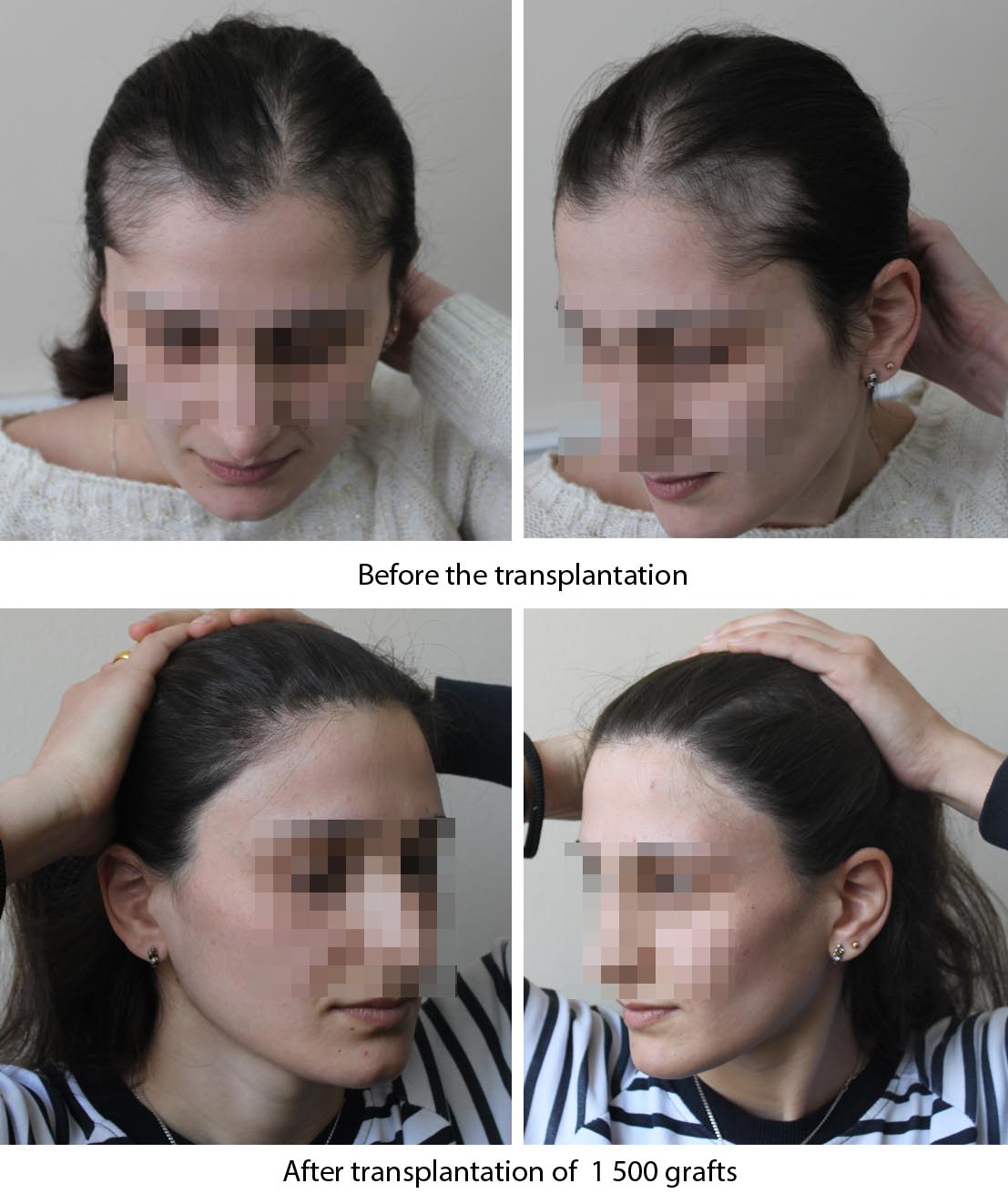 Female hair restoration results -   before and after. Dr Akaki Tsilosani, MD, PhD, FISHRS