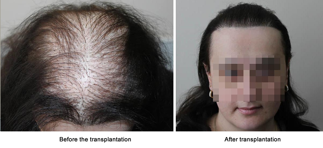 Female hair restoration results -   before and after. Dr Akaki Tsilosani, MD, PhD, FISHRS