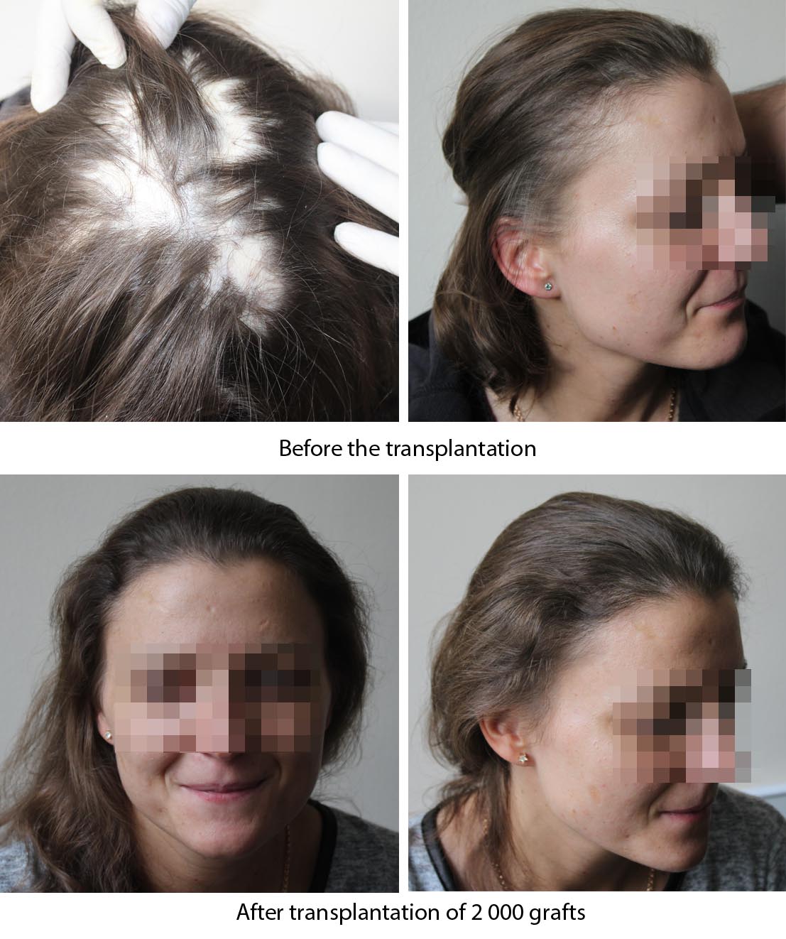 Female hair restoration results -  до и после. Проф. Акакий Цилосани