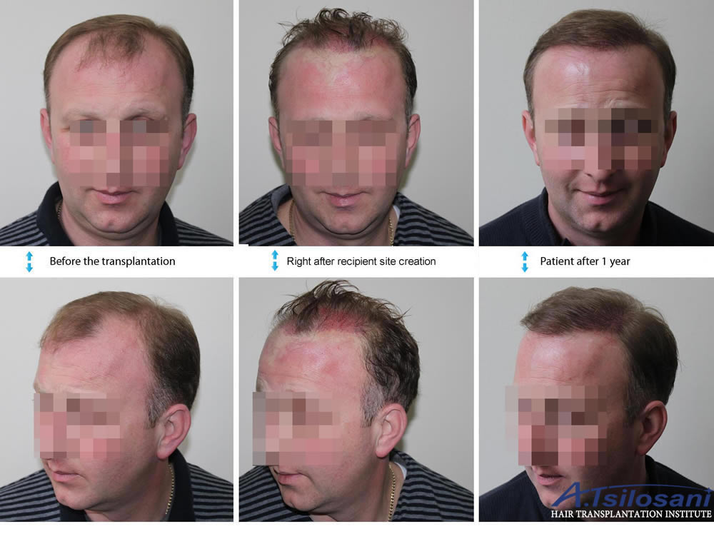 Long Hair Transplant - Before & after. Dr Akaki Tsilosani, MD, PhD, FISHRS