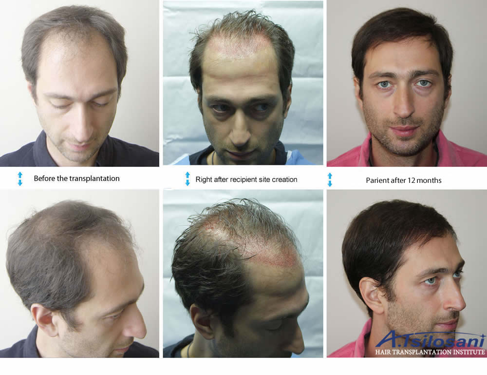 Long Hair Transplant - Before & after. Dr Akaki Tsilosani, MD, PhD, FISHRS