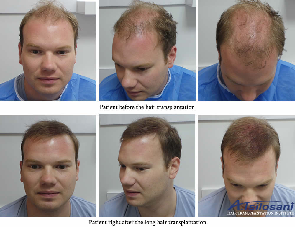 Long Hair Transplant - Before & after. Dr Akaki Tsilosani, MD, PhD, FISHRS