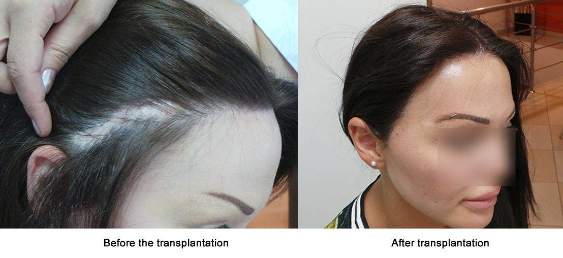 Female hair restoration results -   before and after. Dr Akaki Tsilosani, MD, PhD, FISHRS