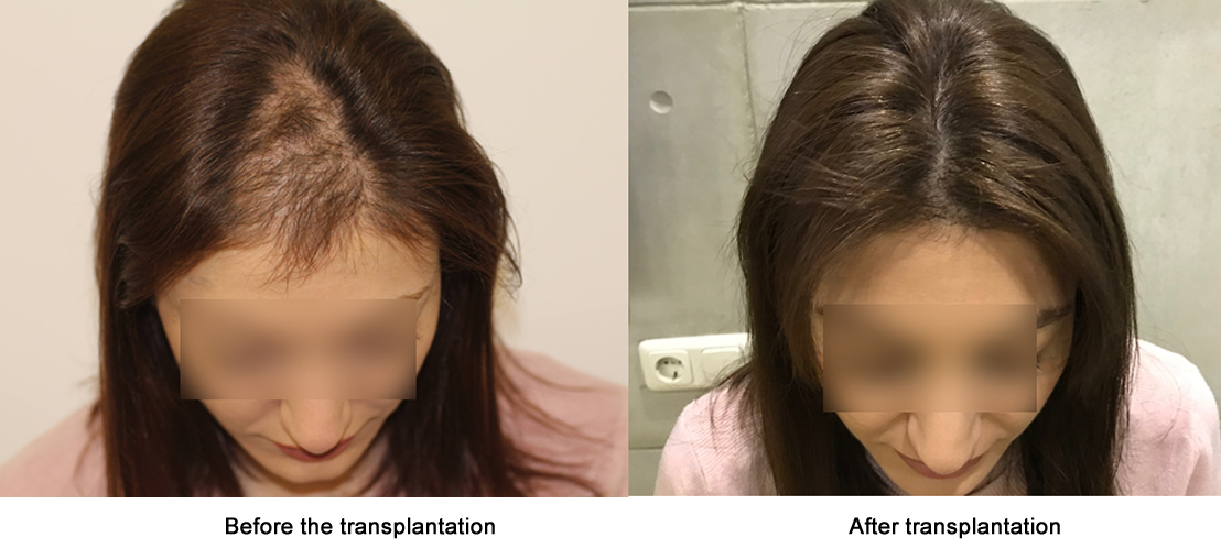 Female hair restoration results -   before and after. Dr Akaki Tsilosani, MD, PhD, FISHRS