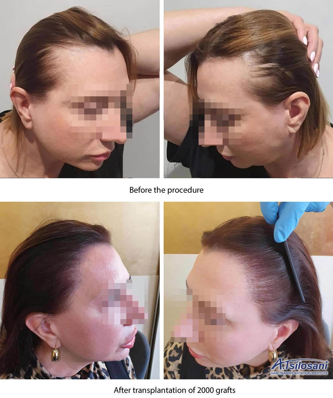 Female hair restoration results -   before and after. Dr Akaki Tsilosani, MD, PhD, FISHRS