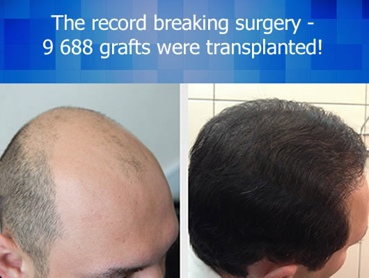 record-breaking hair transplant