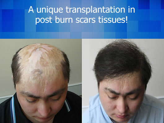 hair restoration in post-burn