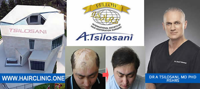 Hair Transplantation in scars - before and after