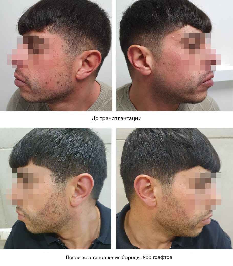 Восстановление бороды -  до и после. Проф. Акакий Цилосани