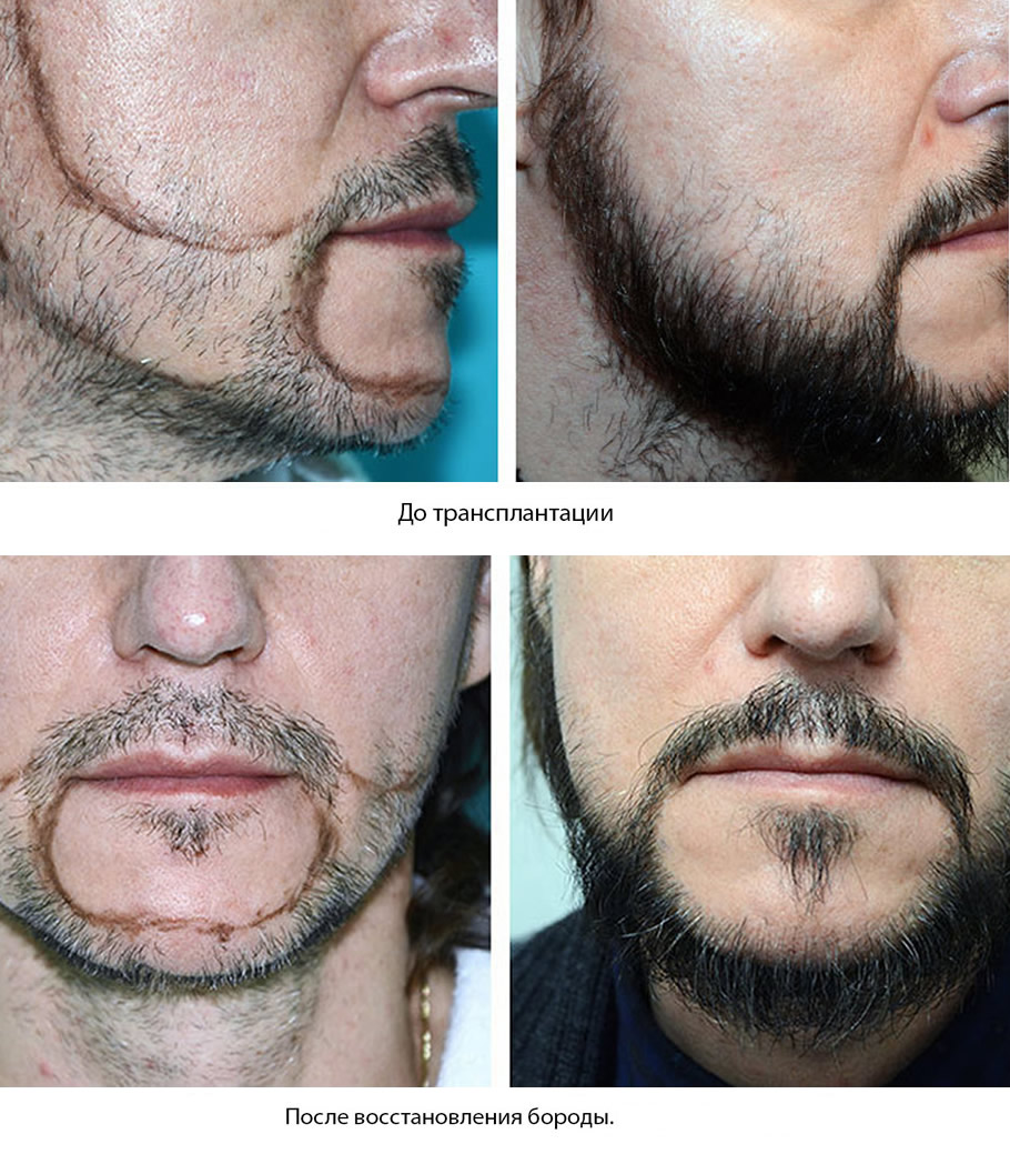 Восстановление бороды -  до и после. Проф. Акакий Цилосани