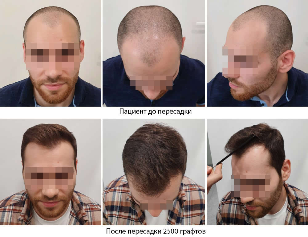 Пересадка волос у мужчин -  до и после. Проф. Акакий Цилосани