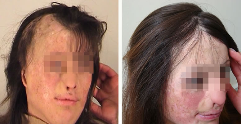 Восстановление бороды -  до и после. Проф. Акакий Цилосани