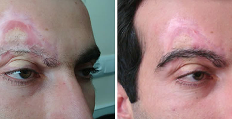 Восстановление бороды -  до и после. Проф. Акакий Цилосани