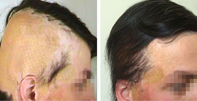 Восстановление бороды -  до и после. Проф. Акакий Цилосани