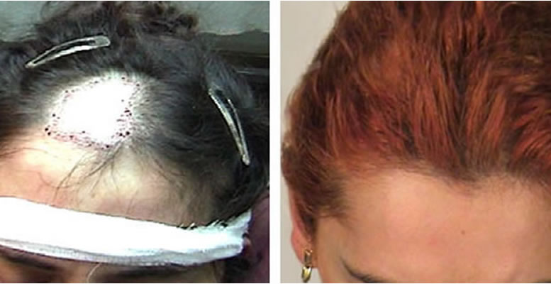 Восстановление бороды -  до и после. Проф. Акакий Цилосани