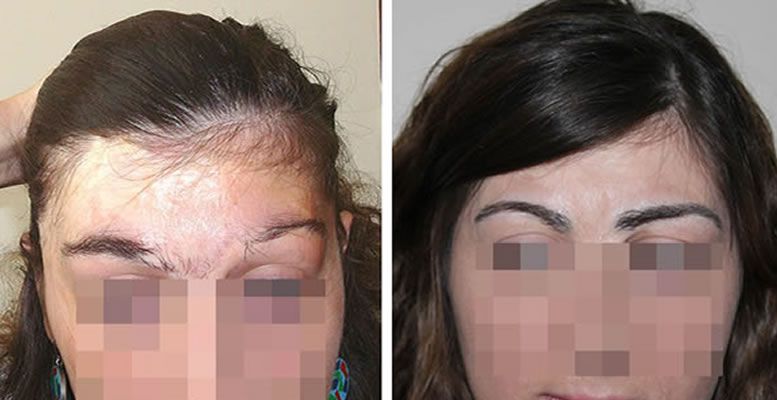 Восстановление бороды -  до и после. Проф. Акакий Цилосани