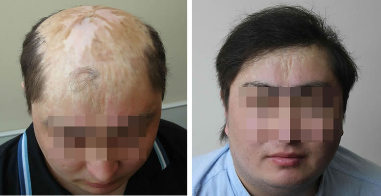 Восстановление бороды -  до и после. Проф. Акакий Цилосани