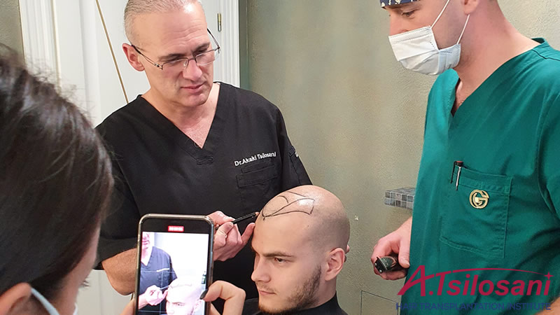 Which Hair Transplant Method is Best?