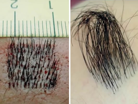 Пересадка волос