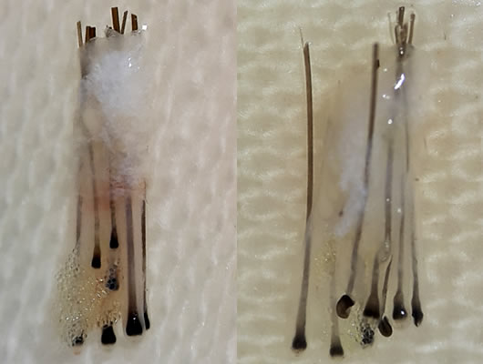 Пересадка волос