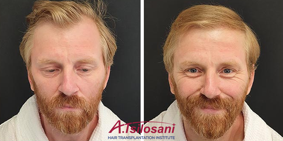 Пересадка волос у мужчин -  до и после. Проф. Акакий Цилосани