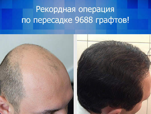 Пересадка волос