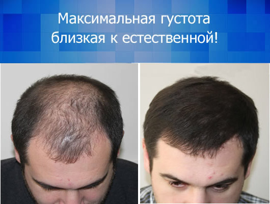 Пересадка волос