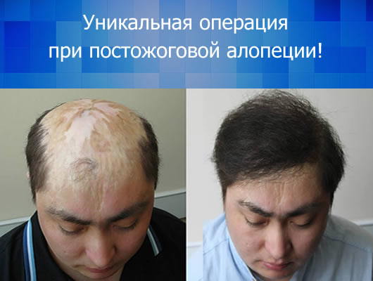 Пересадка волос